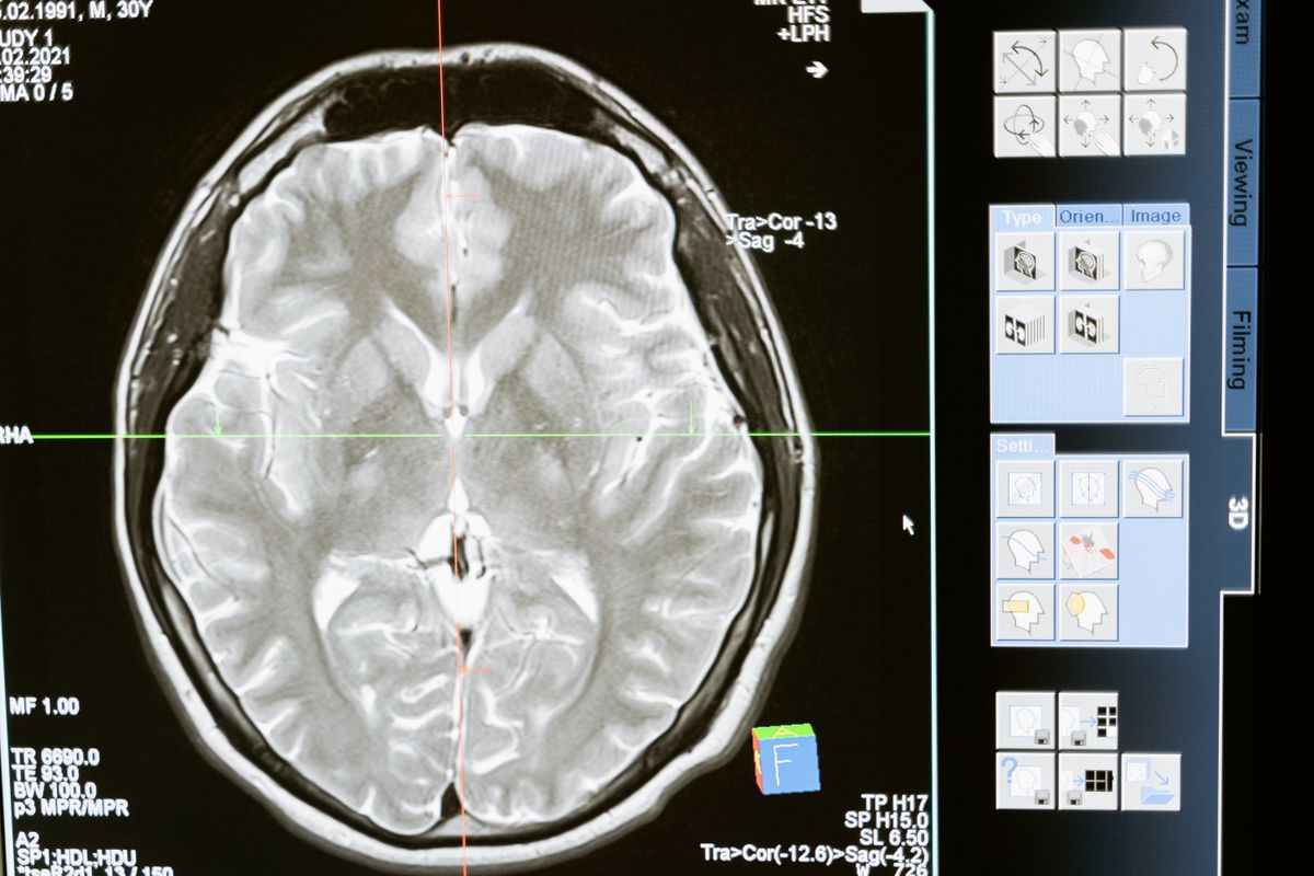 A brain scan displayed on diagnostic imaging software